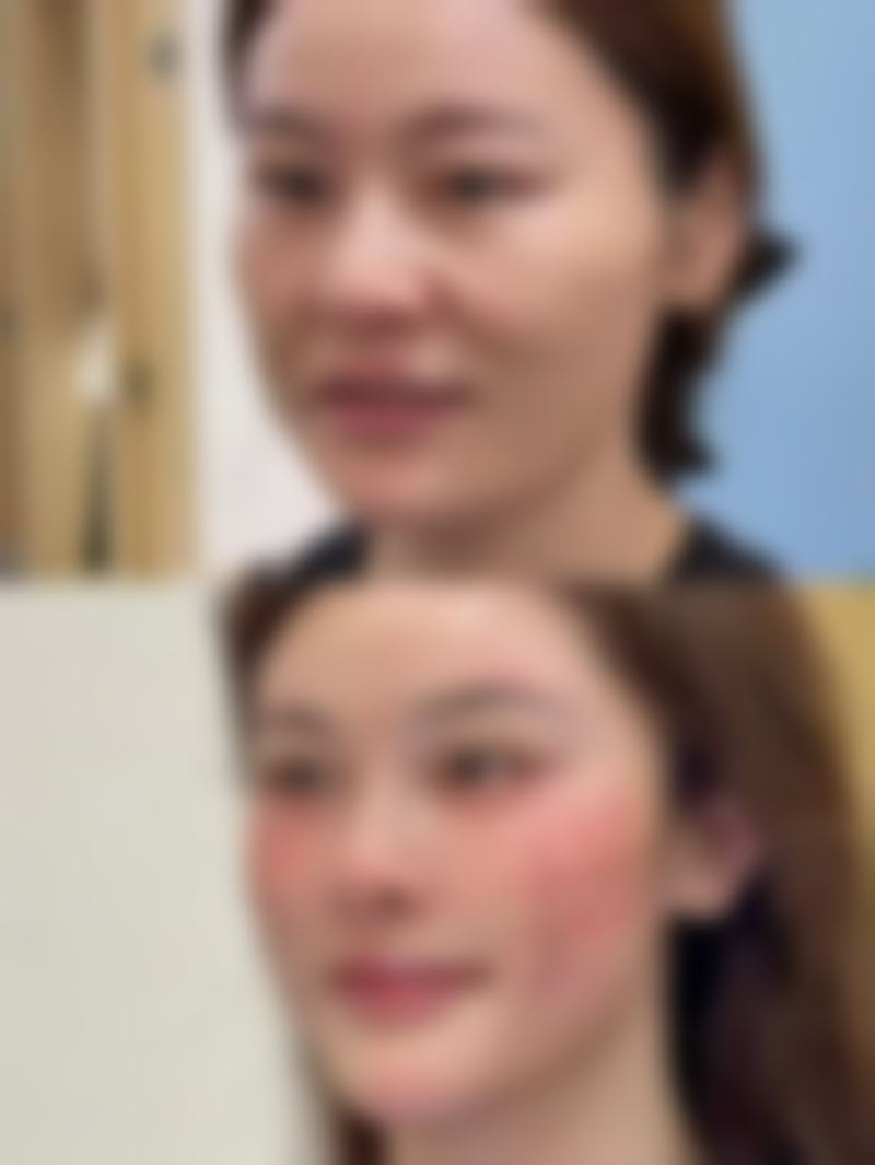 一、疤痕后皮肤变白的原因