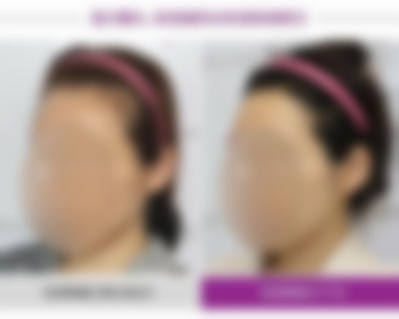 七、做全切双眼皮多久消肿？结尾总结