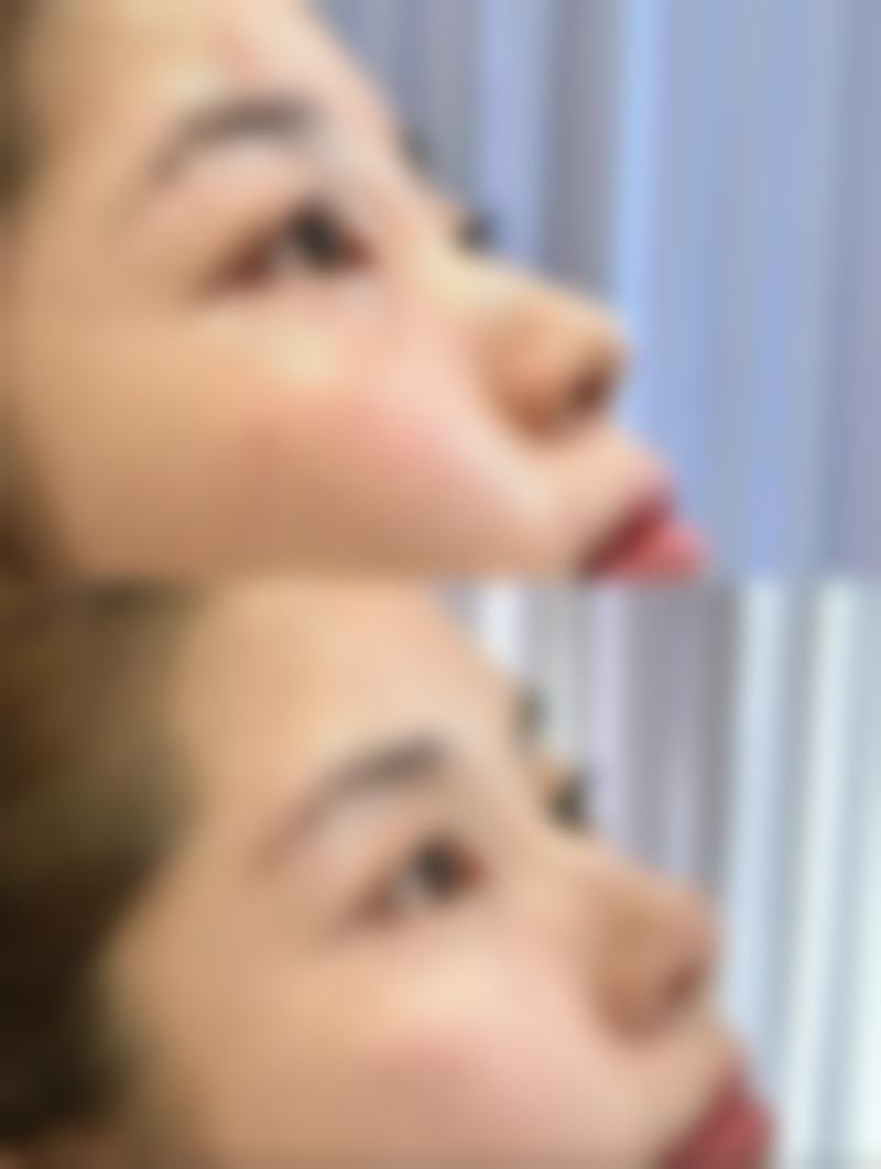 二、去增生疤痕怎么办？涂抹药膏来帮忙