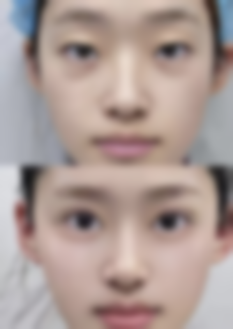 四、雕线隆鼻可以维持多久？如何延长维持时间