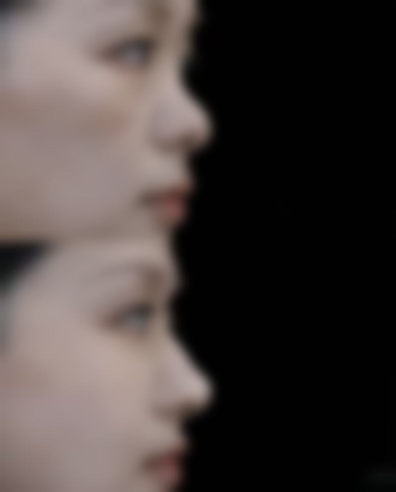 三、吸脂1000毫升的成效和影响