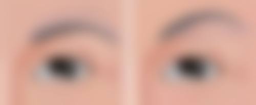 二、去除脸上凹陷疤痕的方法