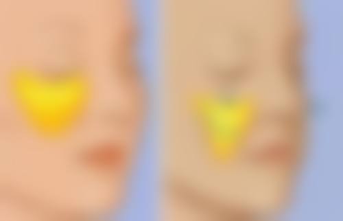 二、隆鼻修复手术前的准备工作