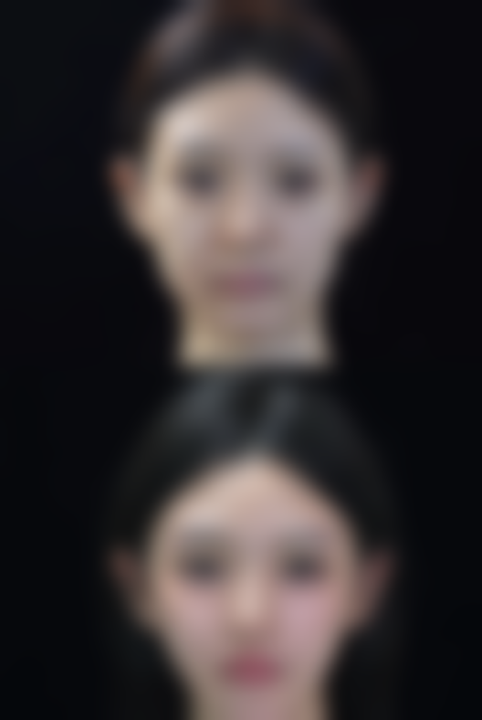 三、隆鼻修复手术后的注意事项