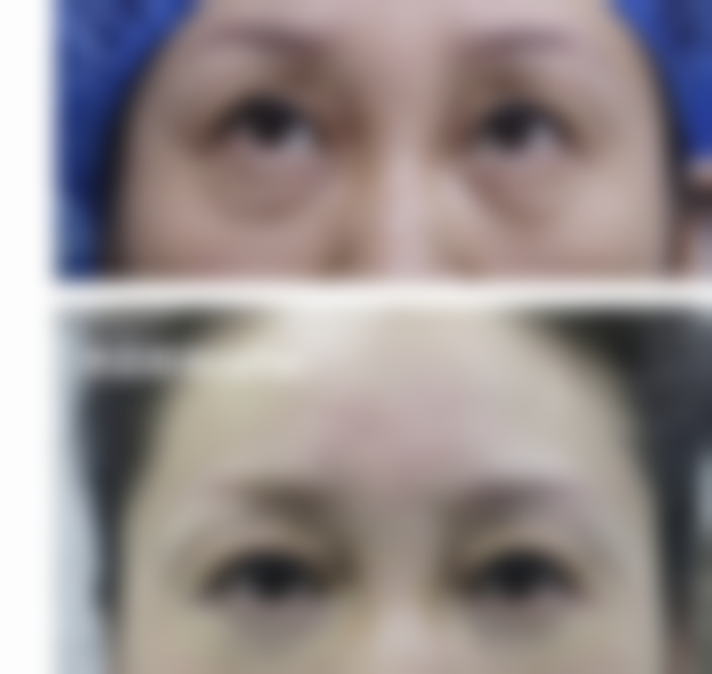 一、粉毒除皱的原理及成效展现