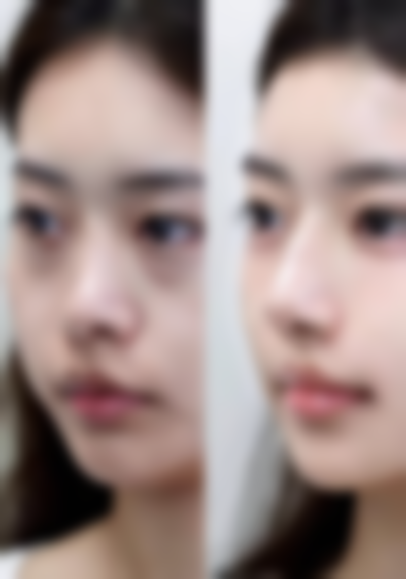 三、巴婷美疤痕修复中 心怎么样之真实实例