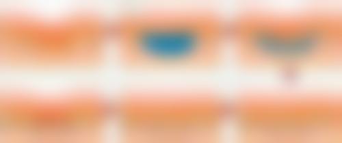 疤痕体质汗管瘤怎么办？掌握这些方法或能安全有效消除汗管瘤！ 