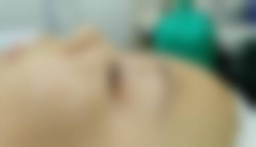 五、手臂抽脂手术安心吗？常见疑问解答