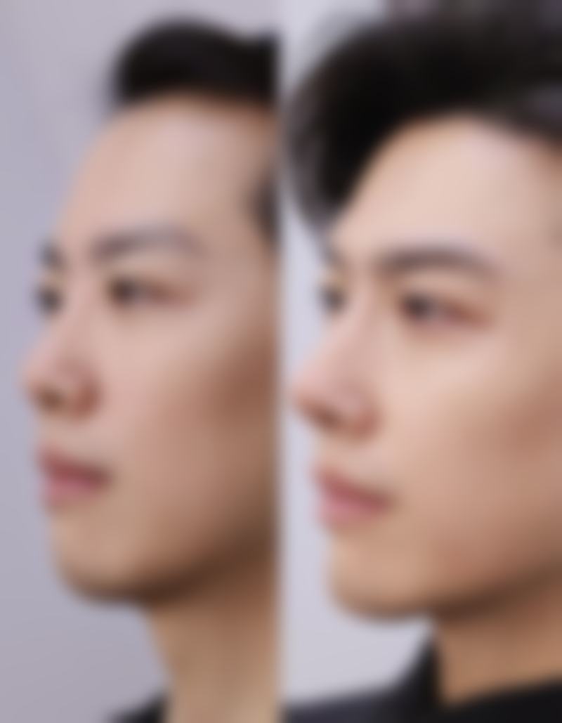 二、手臂抽脂手术安心吗？潜在风险全知晓