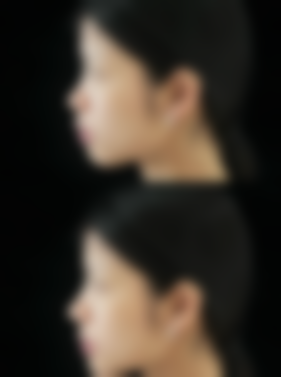 三、割的双眼皮发炎该怎么治疗