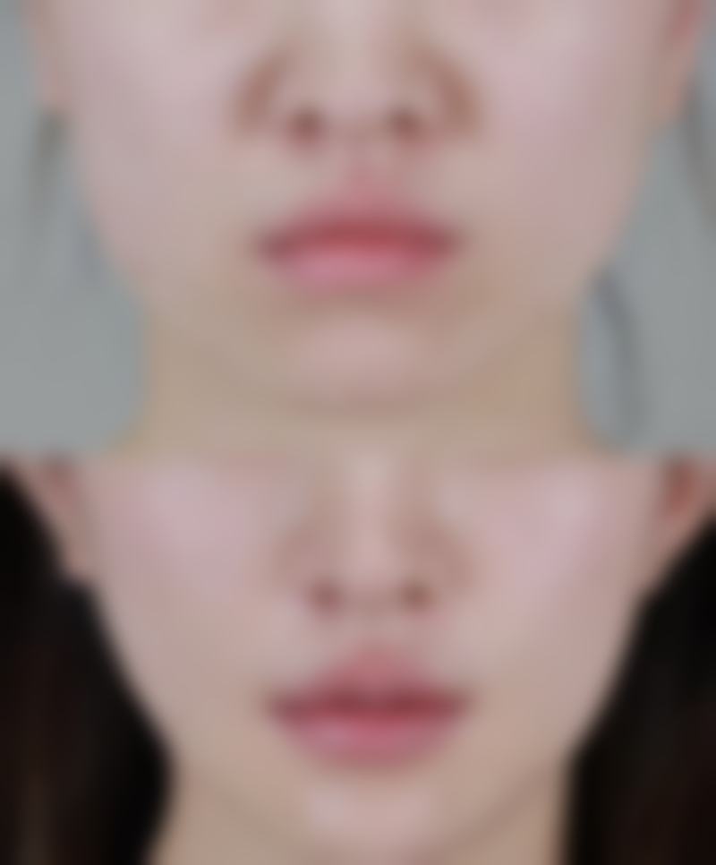 二、割的双眼皮发炎症状表现