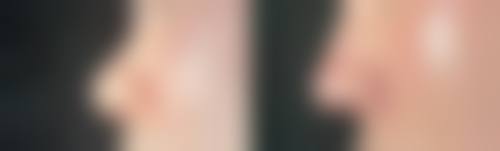 三、双眼皮修复的可行性