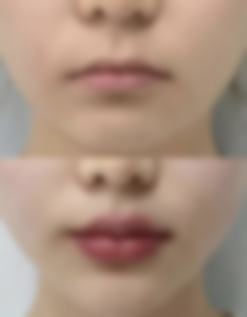 四、瘦脸针打五十单位会没成效吗之维持时间