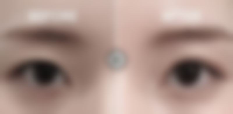 六、瘦脸针打五十单位会没成效吗之总结