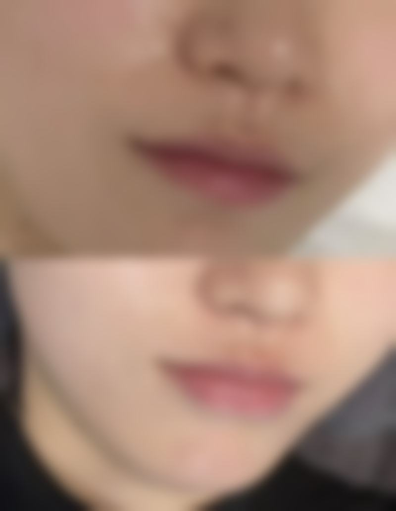 二、双眼皮修复的必要性