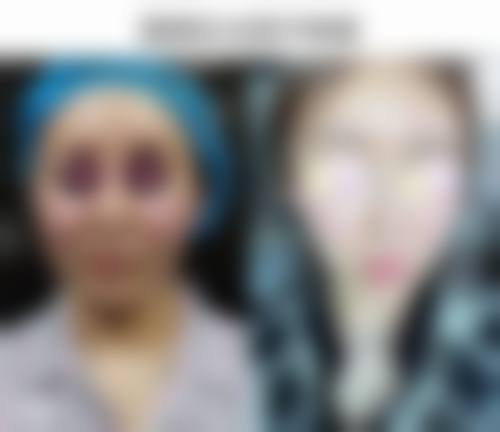 一、鼻子上凹陷疤痕形成的原因