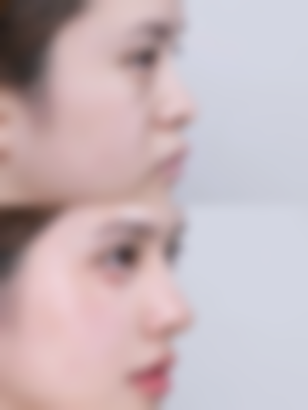 四、治疗鼻子上凹陷疤痕的注意事项