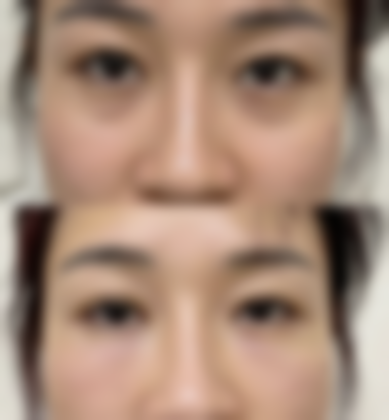 疤痕凝胶能去除妊娠纹吗？探究其效果，为产后妈妈解决妊娠纹困扰 