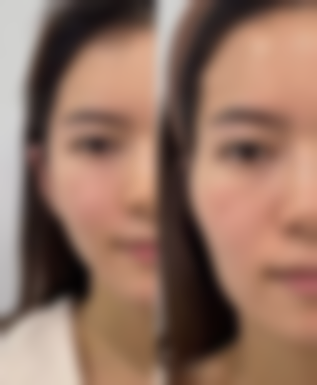 二、认识妊娠纹