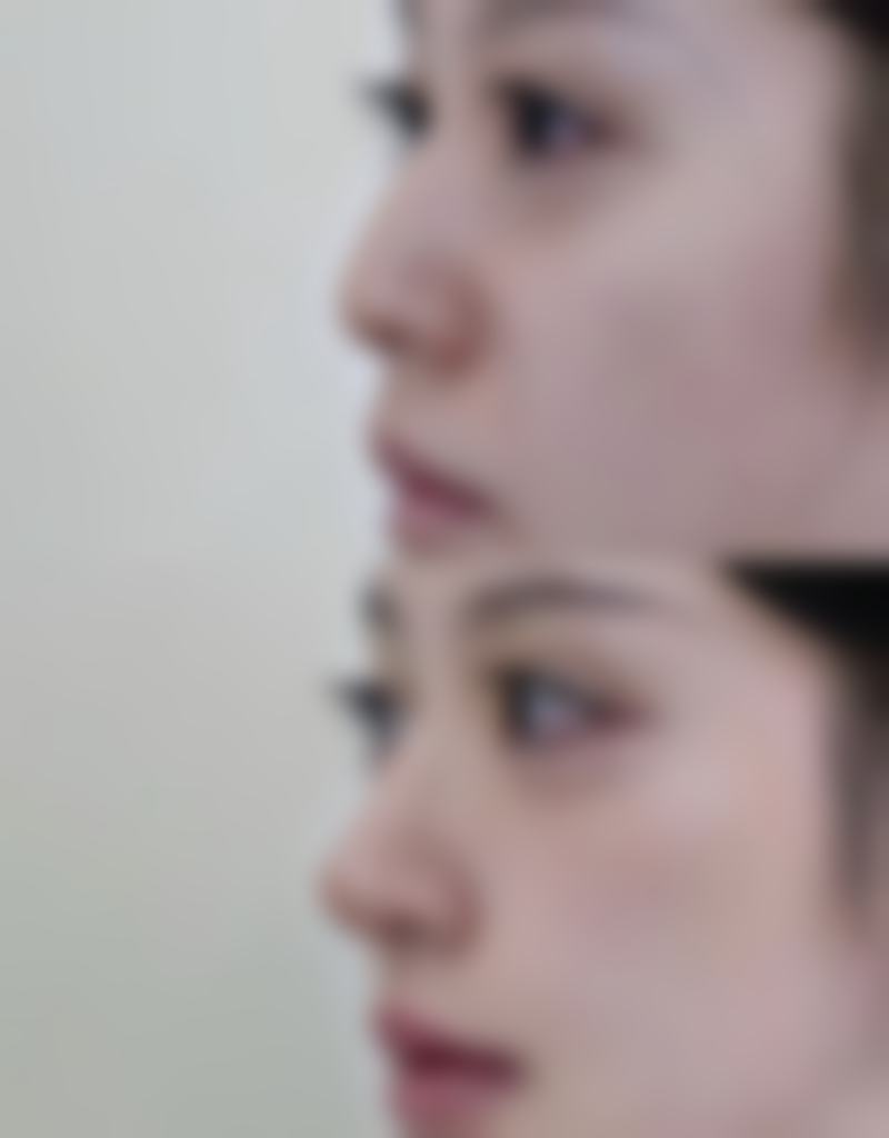 七、脸上疤痕发黑多久修复正常肤色：总结与期望