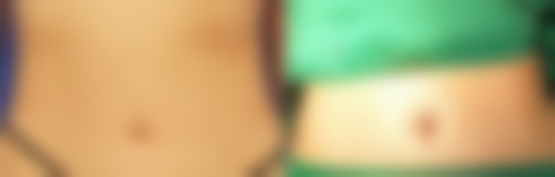 二、下颌角整形手术切口选择