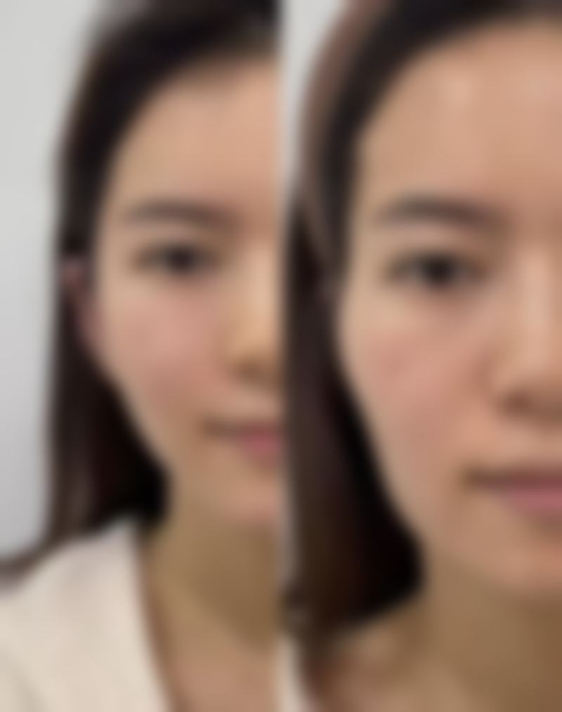 五、进口瘦脸针成效与维持时间