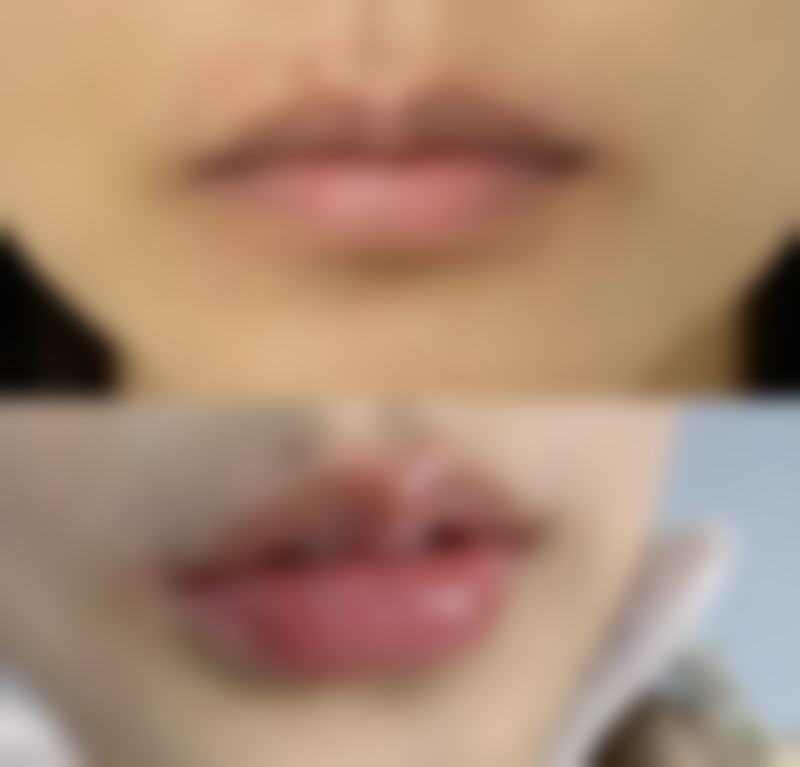 五、5岁宝宝眼袋发紫可能是先天性血管异常