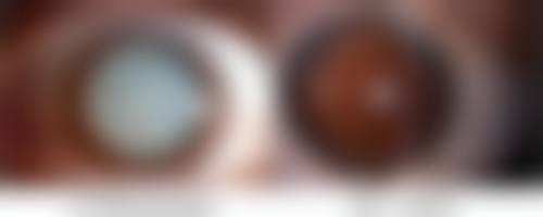 二、怎样去掉脸上的烫伤疤痕之激光治疗法