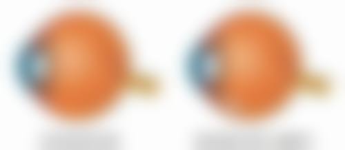 二、假体隆胸改善形状的奇妙成效