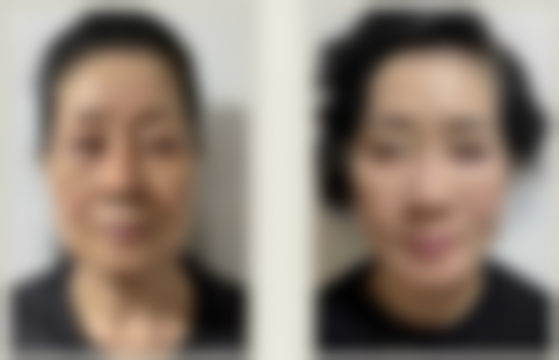 三、三点定位双眼皮重做的方法