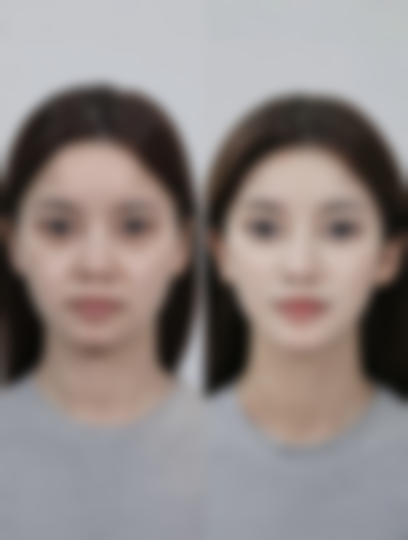 怎样去掉脸上的烫伤疤痕？硅酮凝胶、激光治疗等小妙招助你重塑光滑肌肤 