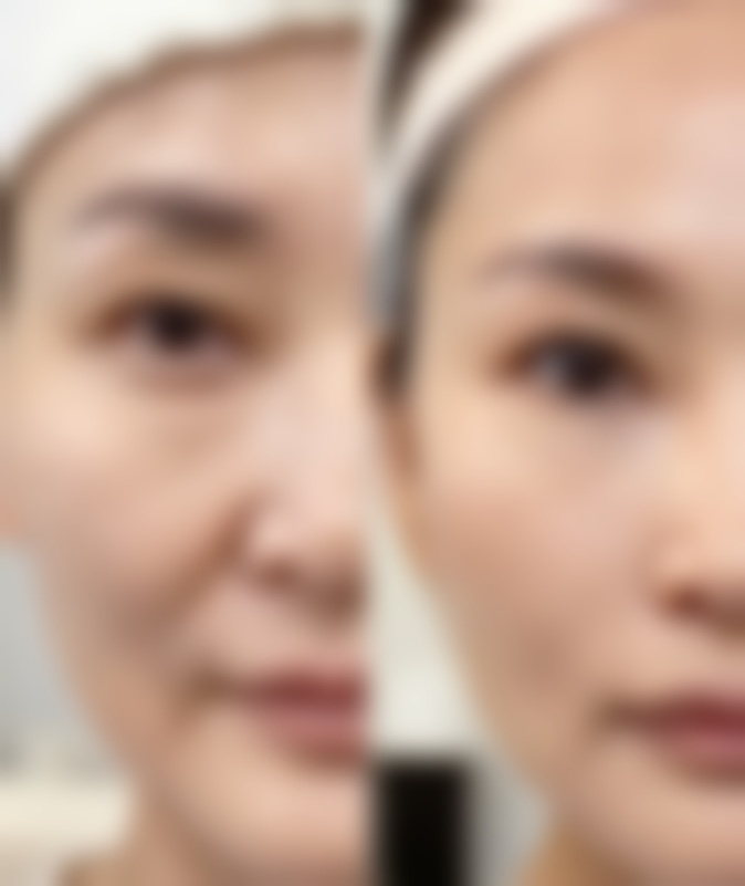 隆胸后多久可以走路？权威解答助你了解术后正常走路时间 