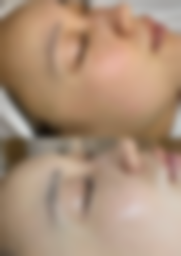 五、假体隆胸的风险与应对措施