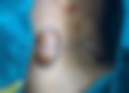 三、割完双眼皮有疤痕正常吗：影响疤痕明显程度的因素