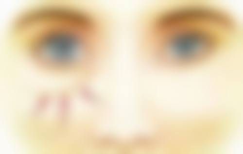 甲状腺术后疤痕增生是什么引起的？伤口发炎、过度刺激、遗传因素或是主因