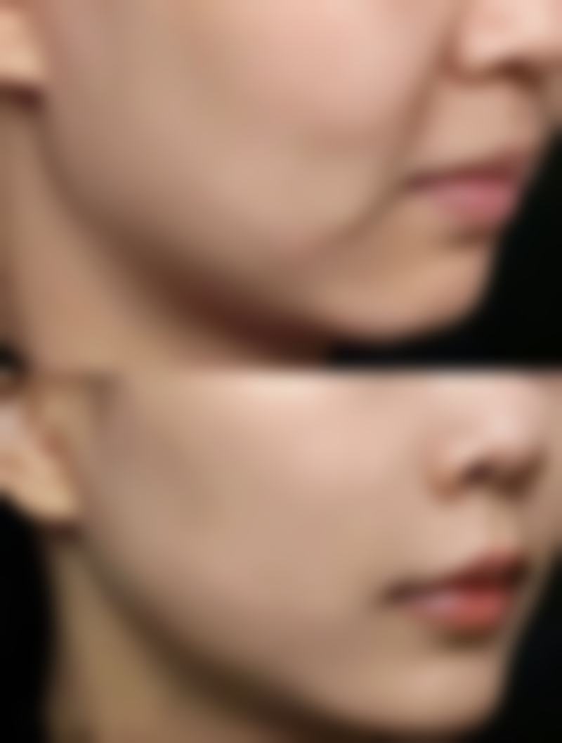 四、Park双眼皮和全切有什么区别之价格差异