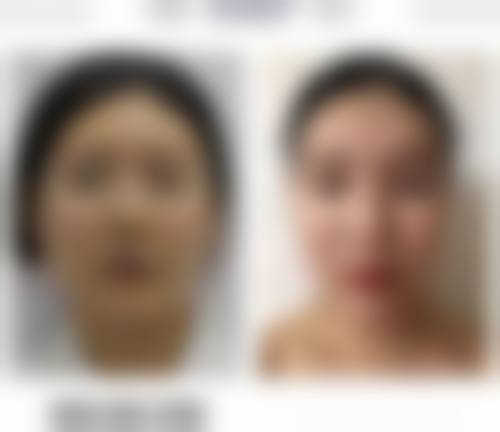 双眼皮贴久了眼皮下垂怎么办？教你从护理到医美多招改善眼皮松弛问题