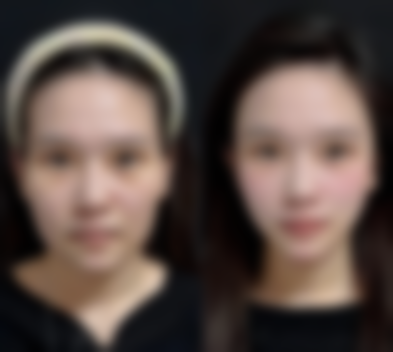 二、线提升隆鼻可以保多久