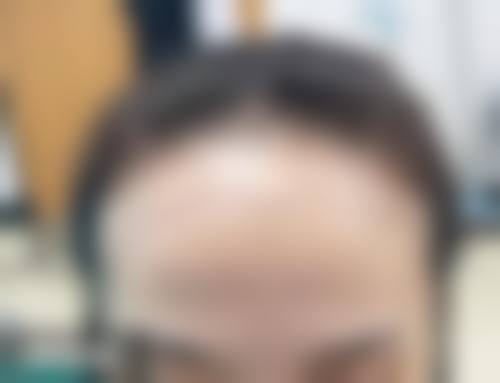 八、西安元邦植发医疗美容诊所真实的患者评价