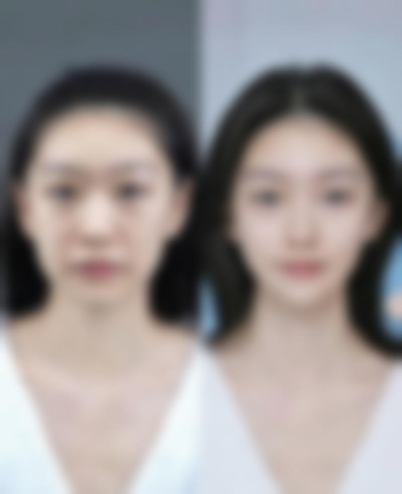 四、打瘦脸针到底有没有用之后遗症分析