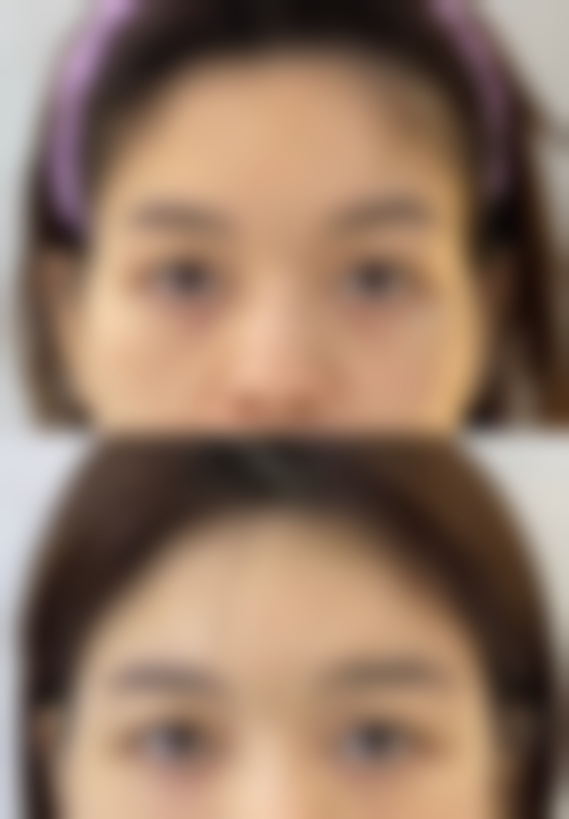 手术疤痕一般怎样可以去除？涂抹药膏、激光治疗、整形手术等方法来支招