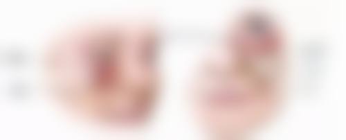 二、不同类型软骨隆鼻的吸收情况