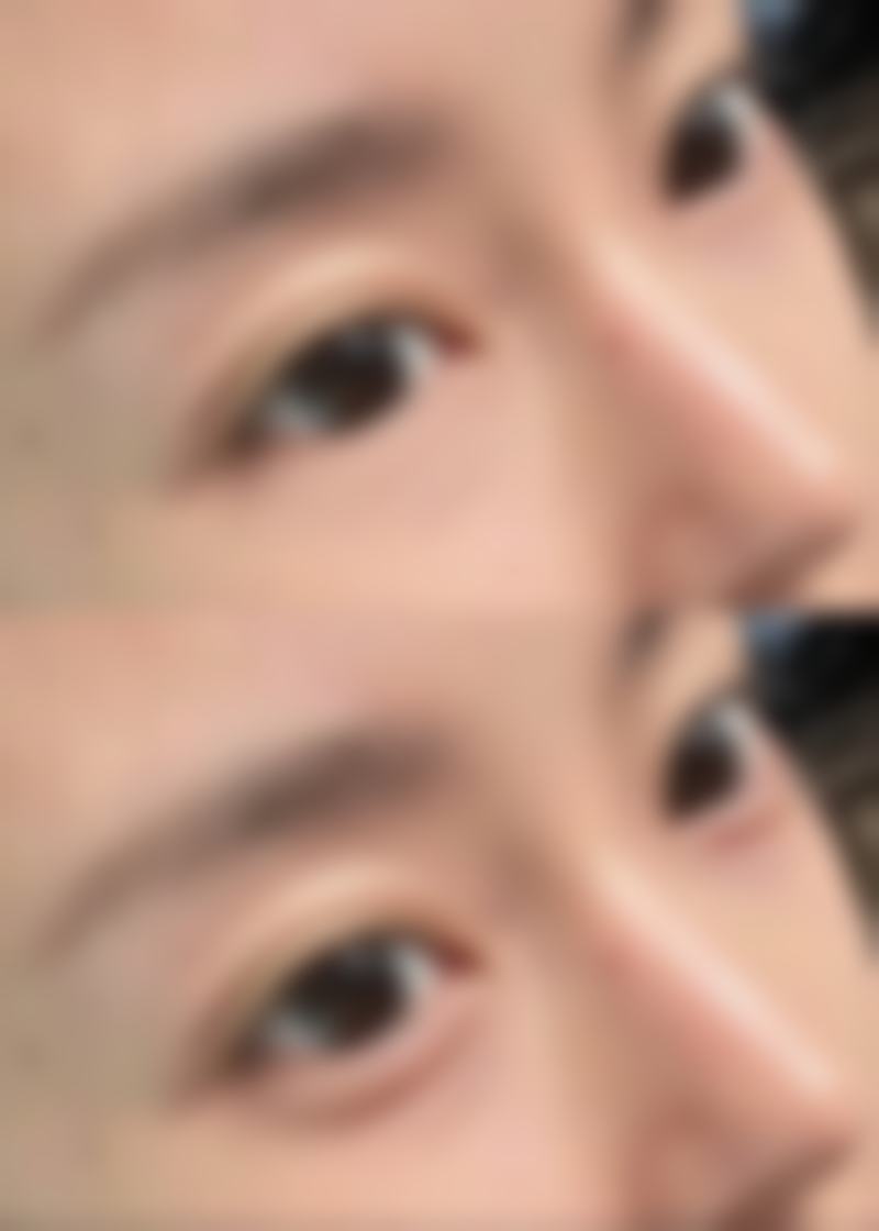 一、割了双眼皮一个月可以化妆吗之术后修复情况