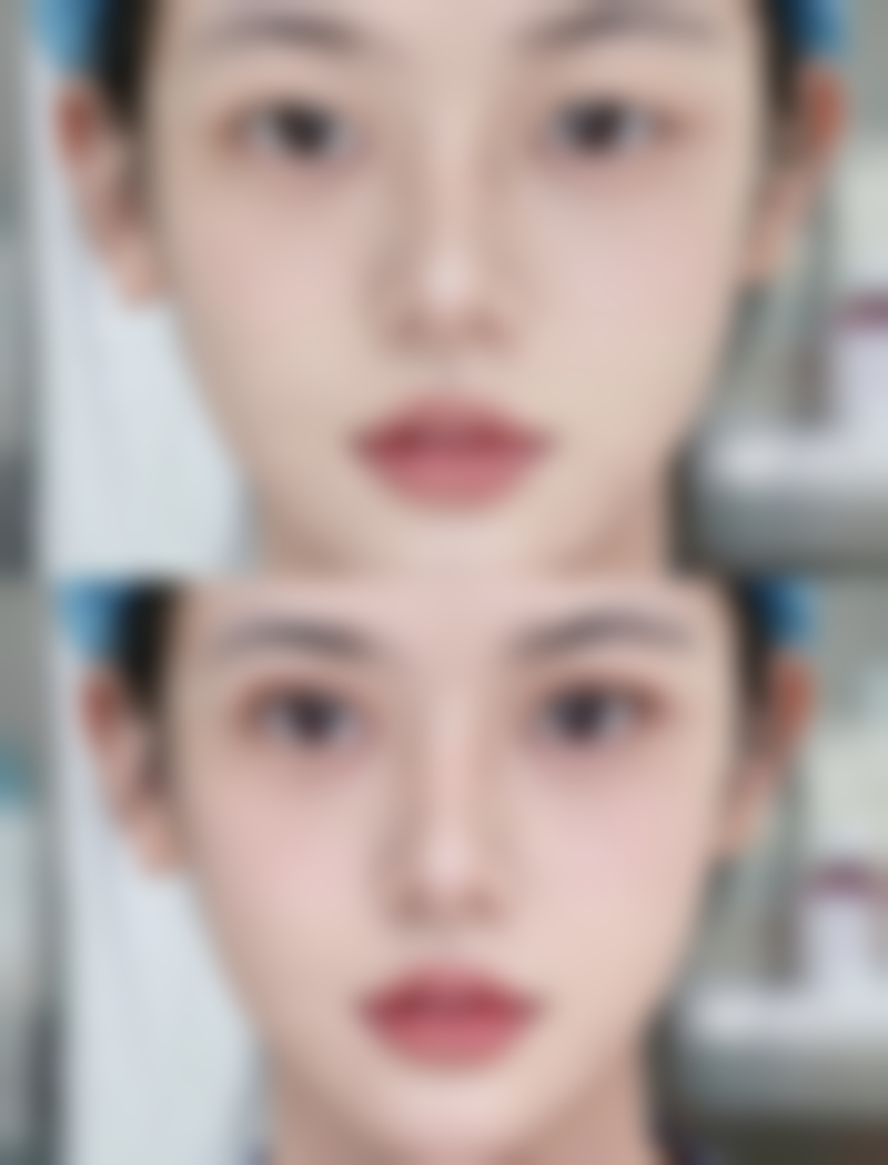 三、影响软骨隆鼻吸收程度的因素