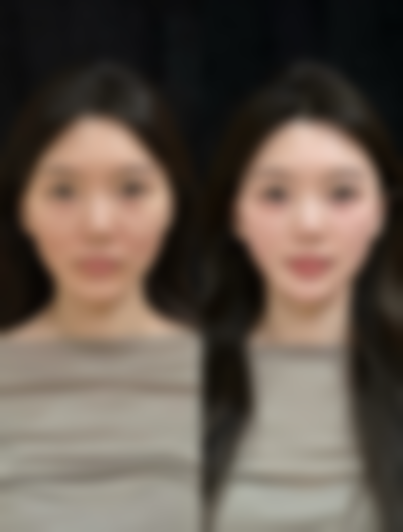一、切痣后疤痕增生的表现与原因