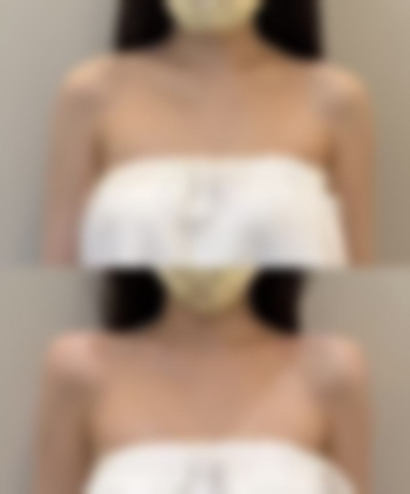 四、切痣后疤痕增生的注意事项