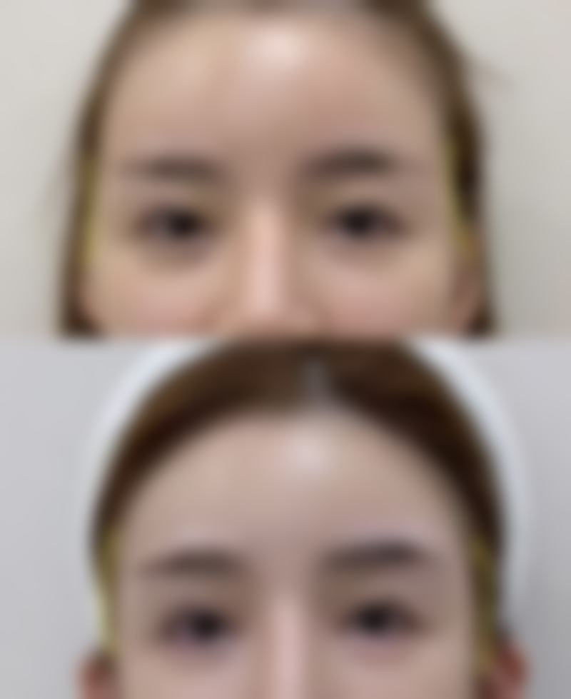 切痣后疤痕增生怎么办？多种改善方法揭秘，附实用图片参考！ 