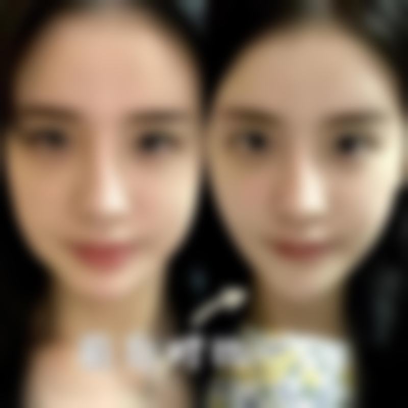一、隆鼻硅胶变形的可能性