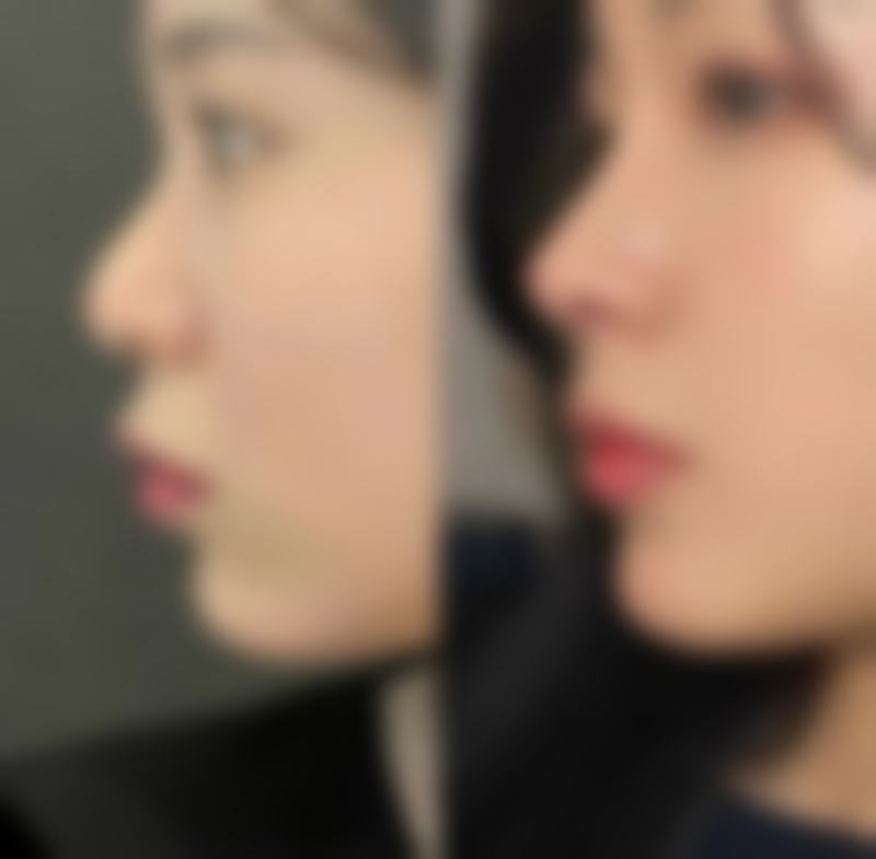 二、不同隆鼻手术类型后的修复时间