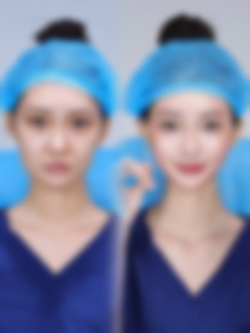 隆鼻硅胶会变形吗？了解变形原因及情况，附相关图片直观解读 